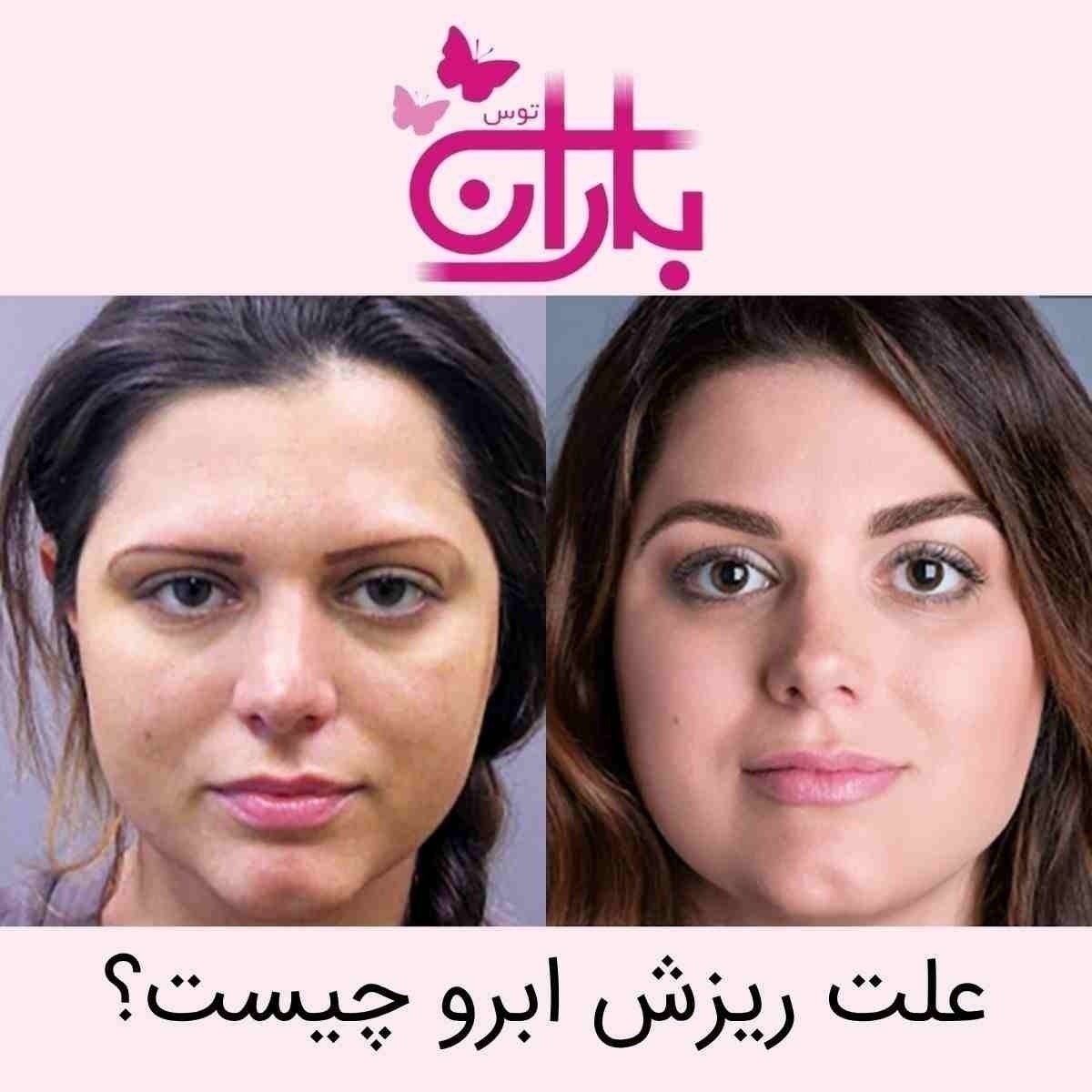 علت ریزش ابرو چیست